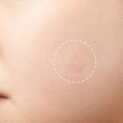 Acne Pimple Master Patch.
